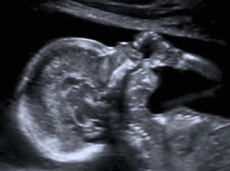 desde en vientre materno, el beb� ya se chupa el dedo